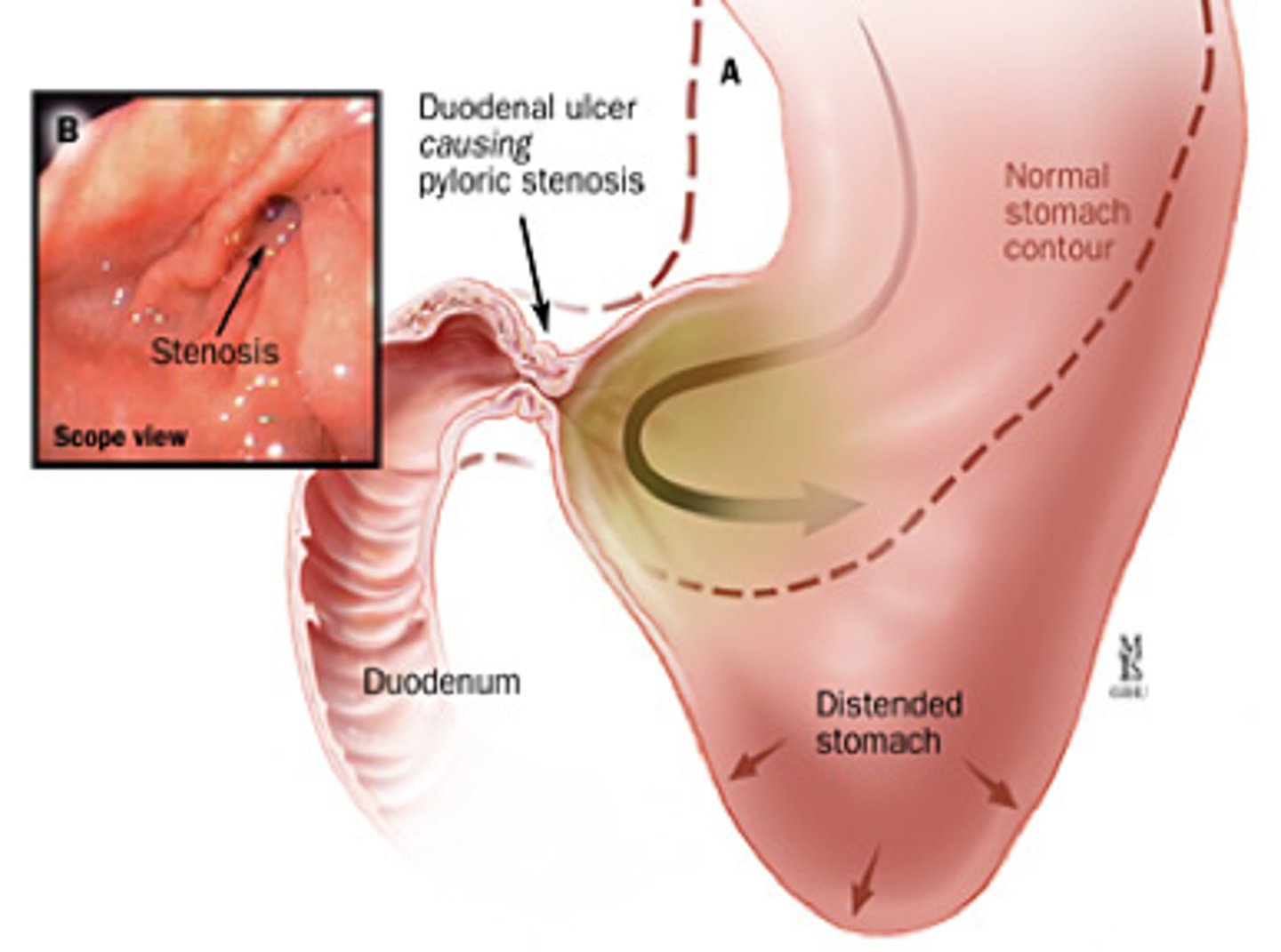 <p>gastric outlet obstruction → succussion splash</p><p>avoid endoscopy</p>