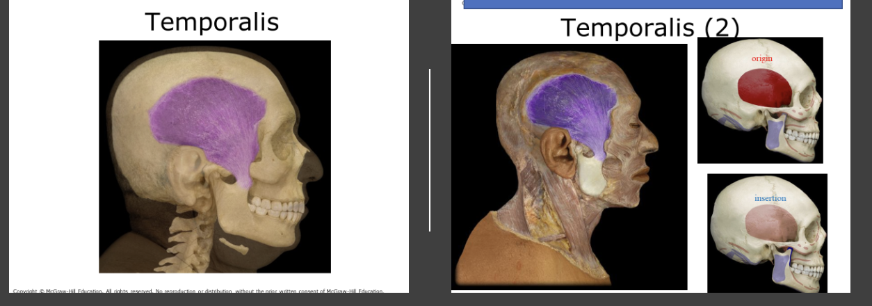 <p>fan shaped muscle over the temporal bone. Raises the mandible for chewing, like the masseter</p>