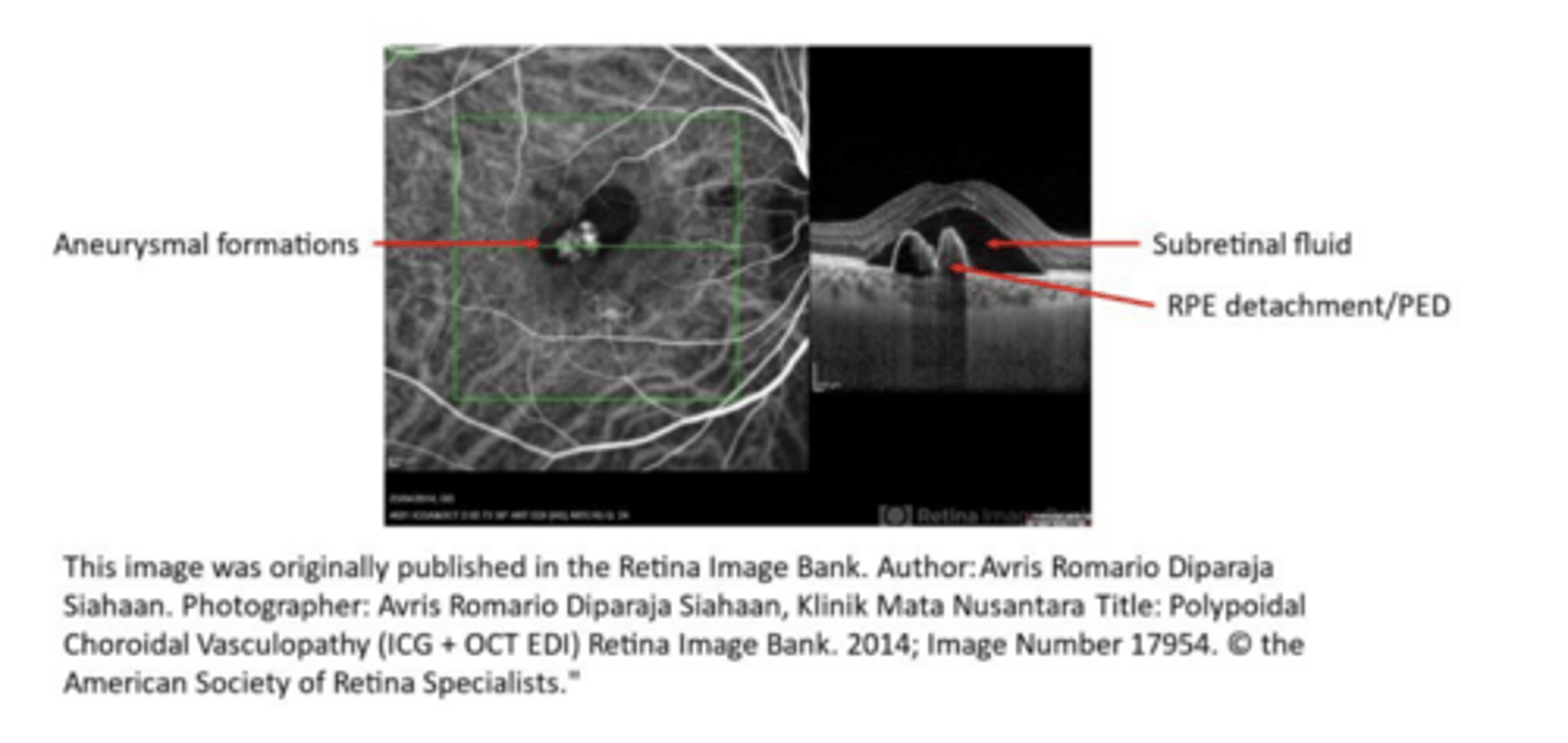 <p>What are the defining characteristics of Polypoidal choroidal vasculopathy/aneurysmal Type 1 Neovascularization (PCV/AT1)?</p>