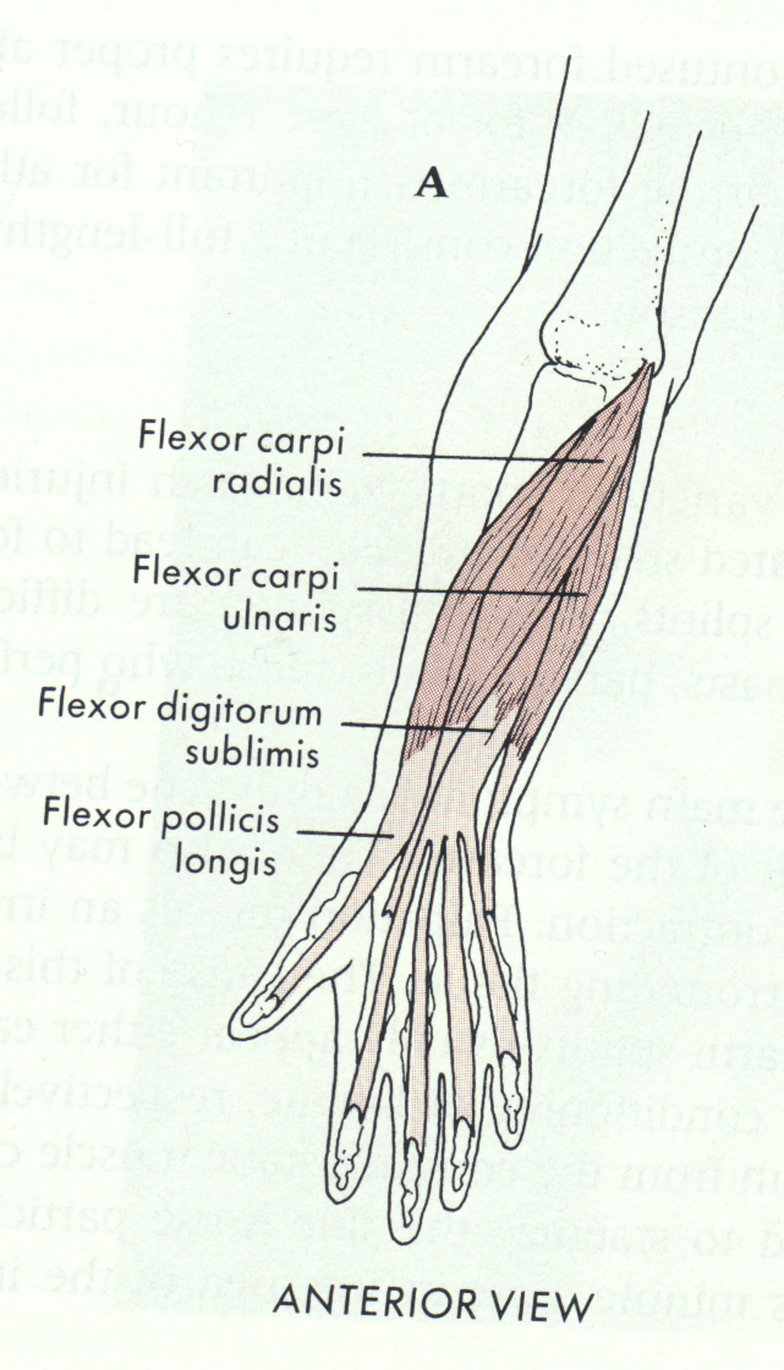 <p>-Originate off M. epicondyle via common flexor tendon</p><ul><li><p>FCR</p></li><li><p>Flexor Digitorum Superficialis</p></li><li><p>Palmaris Longus</p></li><li><p>FCU</p></li><li><p>Flexor Digitorum profundus: O → Proximal ulna, I → distal phalanges of 4 fingers</p></li></ul>