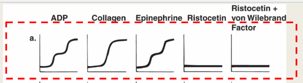 <ul><li><p>ADP: norm</p></li><li><p>Epinephrine: norm</p></li><li><p>Collagen: norm</p></li><li><p>Ristocetin: abnormal</p></li><li><p>Ristocetein +NL plasma: abnormal</p></li></ul><p></p>