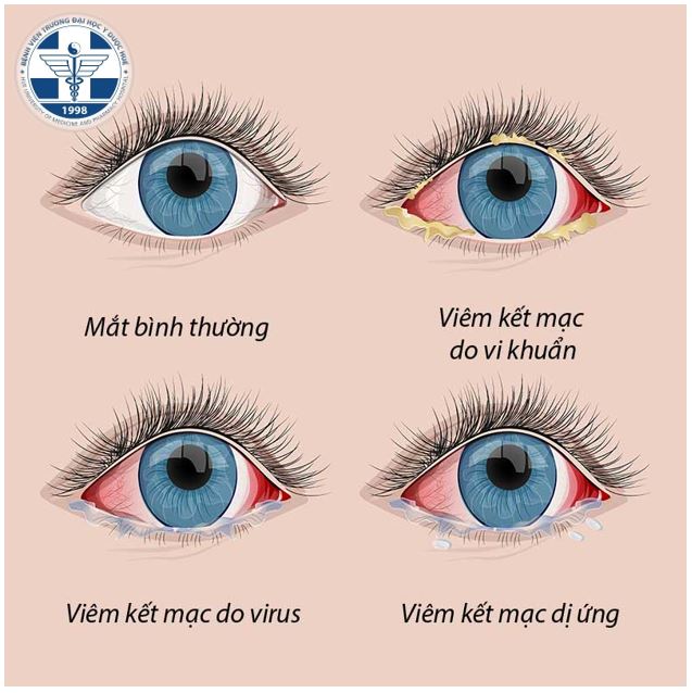<p>viêm kết mạc</p>