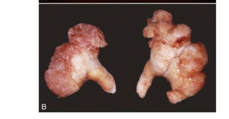 <p>what type of calculi is this?</p>