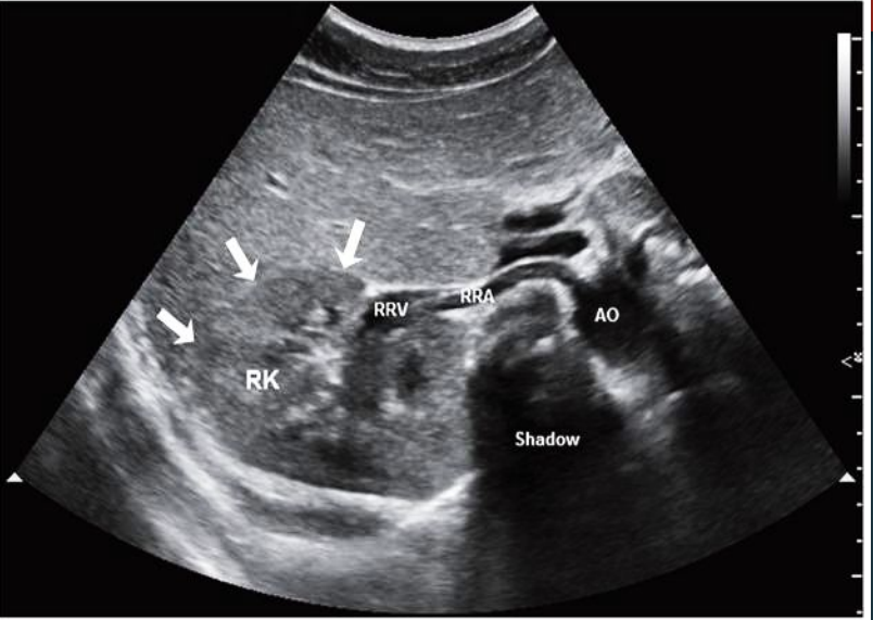 <p>Normal TRV kidney </p>