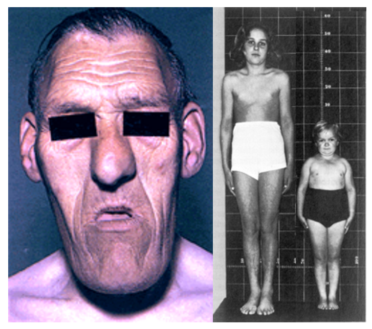 <p>Excess of GH, most often caused by secretory adenoma of somatotroph cells</p><p><u>Signs</u>:</p><ul><li><p>Prepuberty: extreme height (gigantism)</p></li><li><p>Postpuberty: growth of hands, feet, lower jaw (gaps between teeth), lips, nose</p></li><li><p>Cardiovascular disorders</p></li><li><p>Impaired glucose tolerance (diabetes)</p><p></p></li></ul><p><u>Investigations</u>:</p><ul><li><p>High GH, high IGF-1, loss of diurnal GH pattern</p></li><li><p>Elevated glucose</p></li></ul><p></p><p><u>Treatment</u>:</p><ul><li><p>Transphenoidal surgery and radiation (remove tumour)</p></li><li><p>Octreotide (somatostatin analogue)</p></li></ul><p></p>