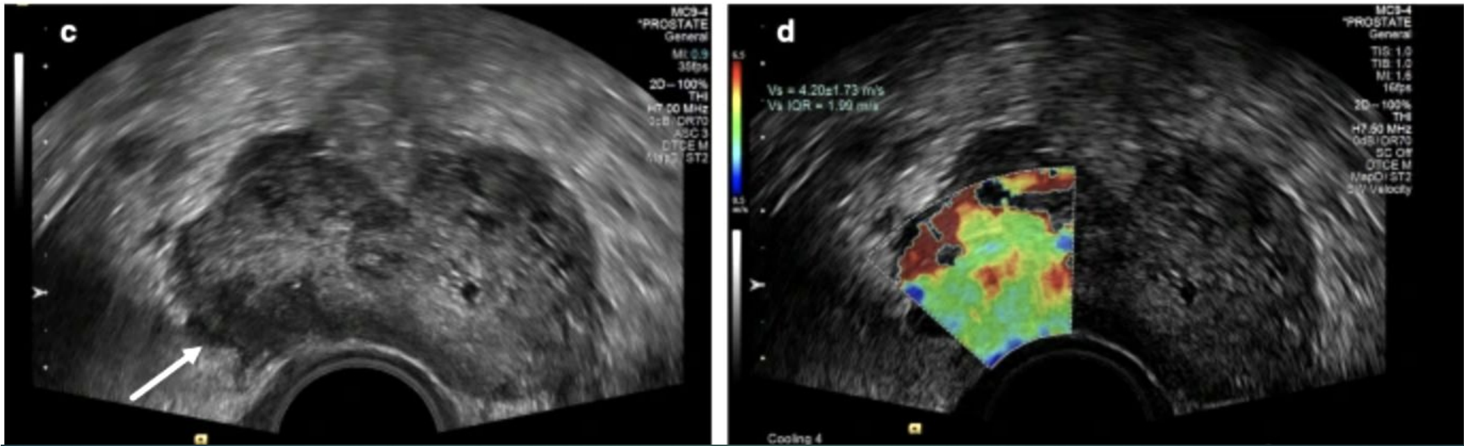 <p>T or F : These images are showing prostate cancer.</p>