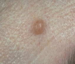 <p>A small, circumscribed lesion usually less than 1cm in diameter that is elevated or protrudes above the surface of normal surrounding tissue</p>