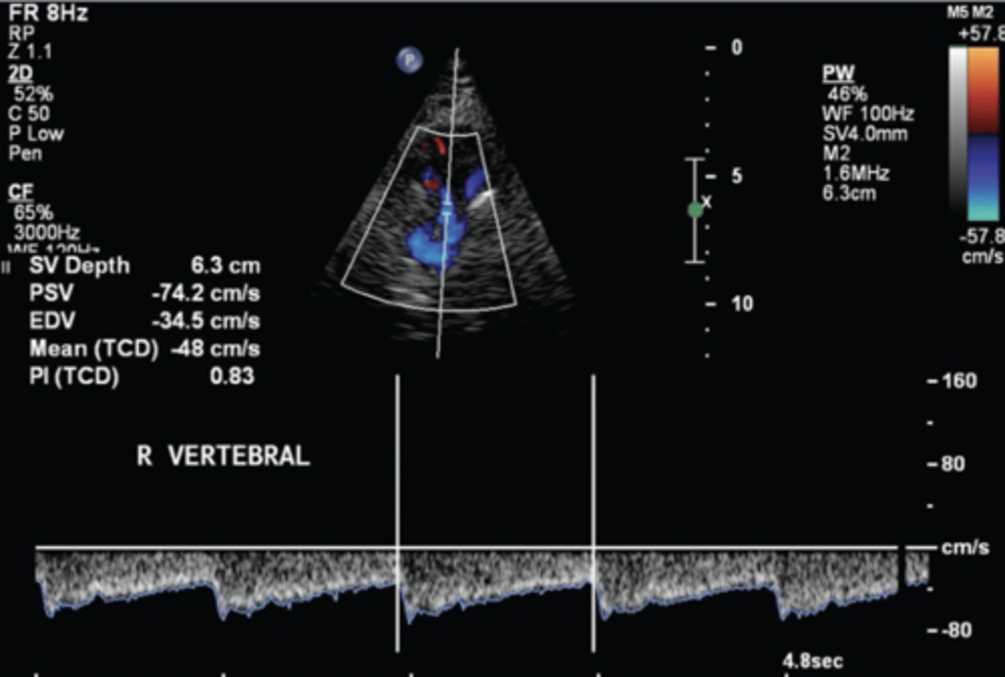 <p>Transforaminal/sub-occipital window</p><p>60-90 mm depth</p><p>Flow away from tx (blue)</p><p>38 +/- 10 cm/sec</p>