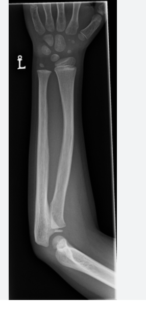 <p>What is a <strong>bowing fracture</strong>?</p>
