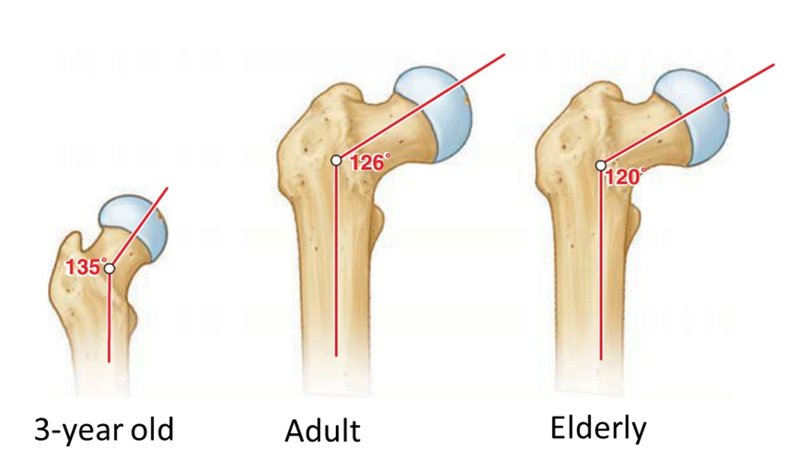 <p><u>femoral neck and femoral shaft</u></p><p></p>