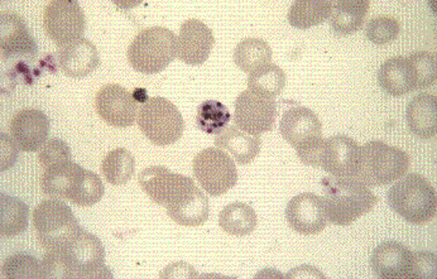 <p>d.P. malariae.</p><p>Plasmodium malariae usually invades older RBCs, perhaps accounting for the occasional darker appearance of the invaded RBC. The life cycle is characterized as quartan, with reproduction occurring every 72 hours and invasion of new RBCs every fourth day. The trophozoite of P. malariae is compact and may assume a characteristic “band” appearance, in which it stretches across the diameter of the RBCs. The mature schizont contains 6 to 12 merozoites with an average of 8. Merozoites may be arranged in a characteristic loose daisy petal arrangement around the clumped pigment as seen in this image.</p>