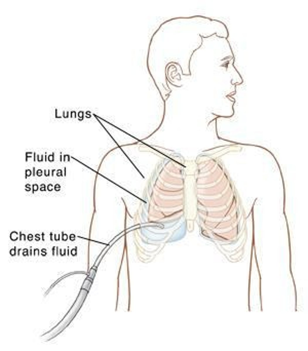 <p>A hollow, flexible tube placed into the chest to drain blood, fluid, or air from around the lungs, allowing the lungs to fully expand.</p>