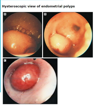 <p><strong>Endometrial Polyps: Presentation and Diagnosis</strong></p><p>-Most common symptom is abnormal uterine _________, typically intermenstrual bleeding </p><p>-Often also found __________ when imaging performed for other reasons </p><p>-Transvaginal ________ is the first-line imaging study </p><p>-Sonohysterography or diagnostic hysteroscopy for the following patients → uncertain findings on TVUS, ____________ patients with a thickened endometrium on TVUS</p><ul><li><p>Those patients need a ______ to rule out cancer </p></li></ul><p></p>