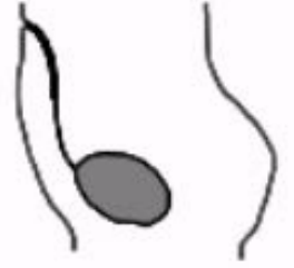 <ul><li><p>About 15% of cases</p></li><li><p>Closes at bladder end but not umbilicus</p></li></ul><p></p>