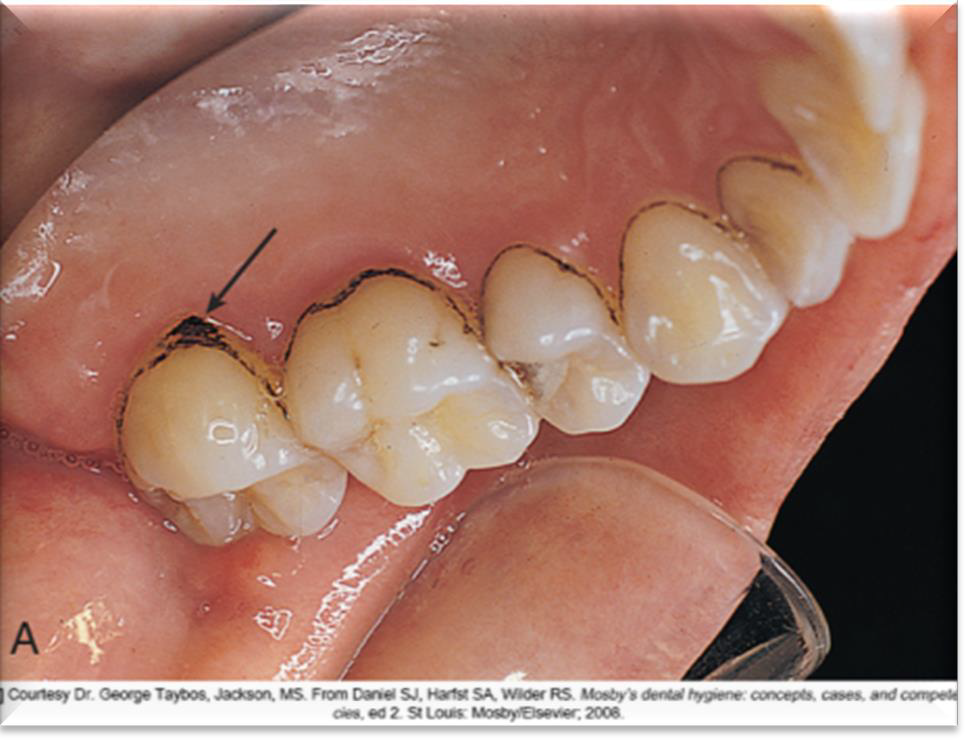 <p>A thin band, about 1 mm wide, located slightly coronal to the gingival margin.</p>