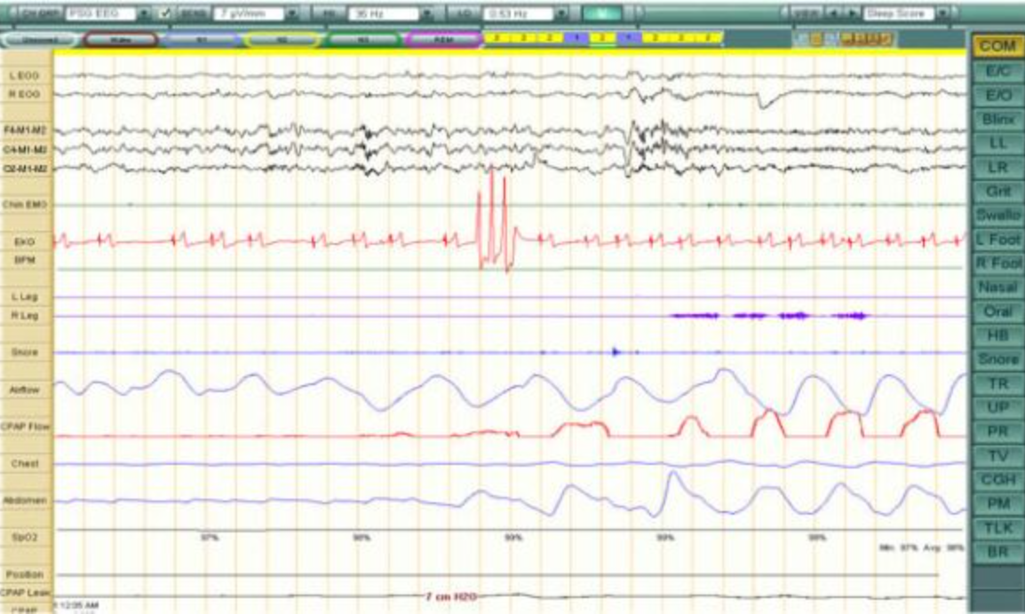 <p>An adult patient has been diagnosed with OSA. During a CPAP titration, the following 30-second epoch is obtained at 10/mm sec. The EEG abnormality at the end of the respiratory event can be described as</p>