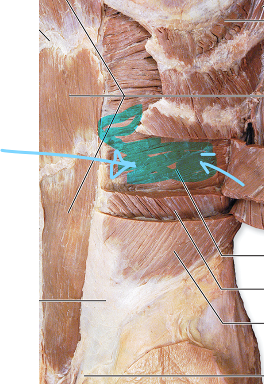 <p>Transversus Abdominis</p>