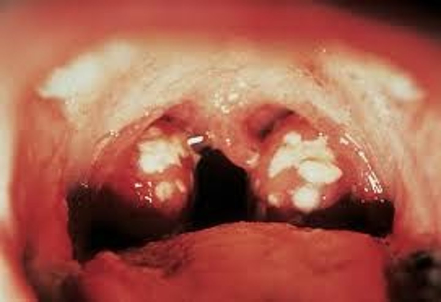 <p>Ans: (A)</p><p>The signs and symptoms exhibited by the client are characteristic of streptococcal pharyngitis, a highly infectious disease. It is appropriate to institute droplet precaution immediately. Informing the physician and providing nourishment and hydration can follow right after.</p>