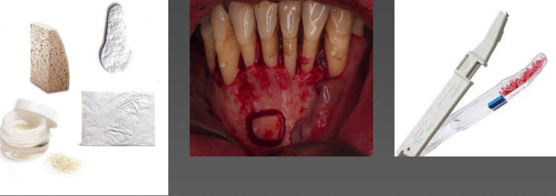 <p>Regeneration membranes (barrier for bone growth instead of ct)</p><p>Artificial bone substitutes</p><p>Autologous bone</p>