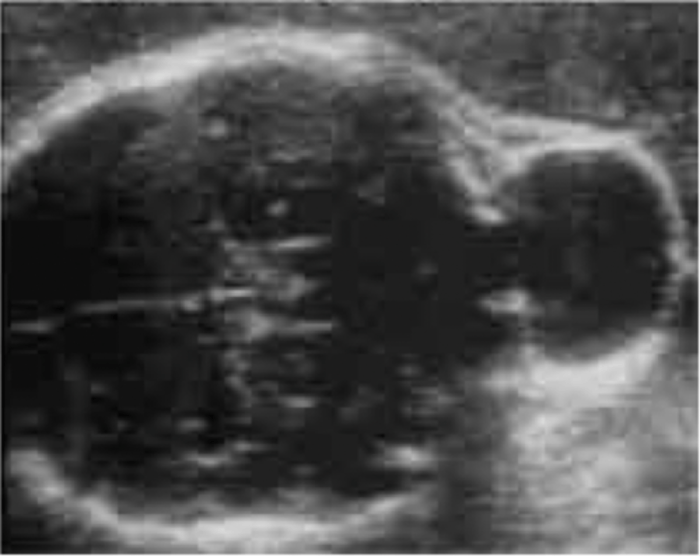 <p>Brain herniates</p>