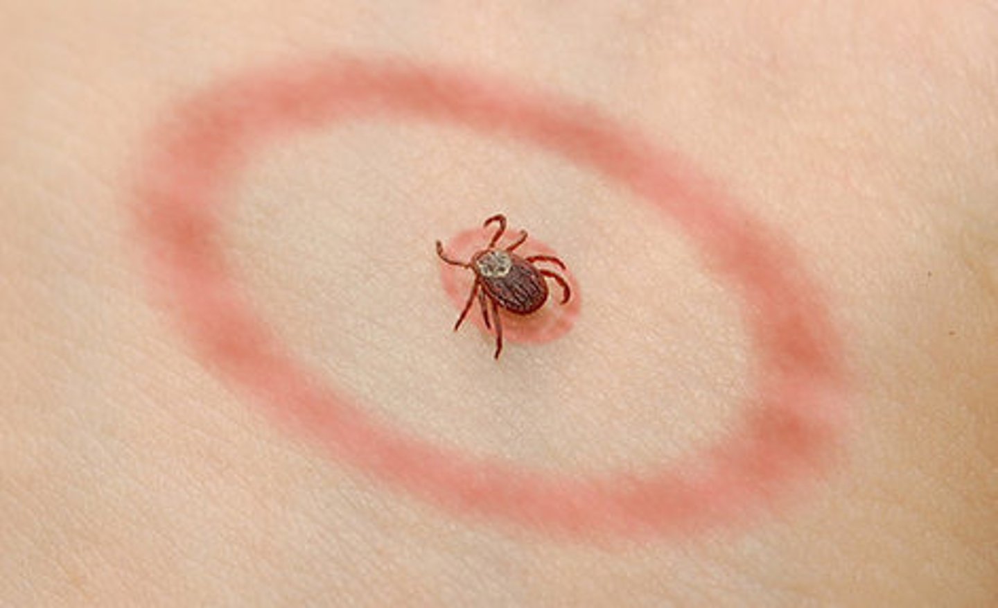 <p>- tick bite</p><p>- red rash (with bull's eye appearance)</p><p>- fevers</p><p>- chills</p><p>- headaches</p><p>- fatigue</p><p>- flu-like symptoms</p><p>contracted by deer ticks</p>