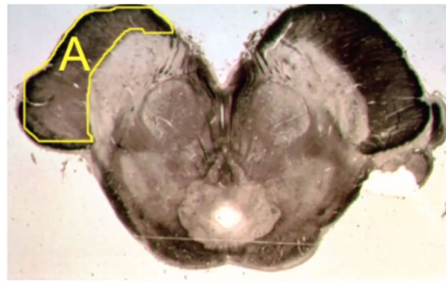 <p>Describe the signs/symptoms if structure "A" is lesioned <br><br>A. Ipsilateral loss of fine touch to the body <br><br>B. Ipsilateral loss of pain &amp; temperature to the face <br><br>C. Contralateral flaccid paralysis to the upper extremity <br><br>D. Ipsilateral loss of vibratory sense to the body <br><br>E. Contralateral spastic paresis to the body</p>