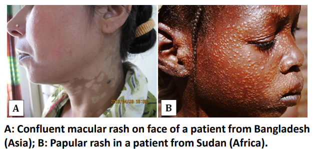 <p>Hypopigmented or erythematous macules papules or nodules appearing on exposed parts of body such as face, arms and upper part of body</p>
