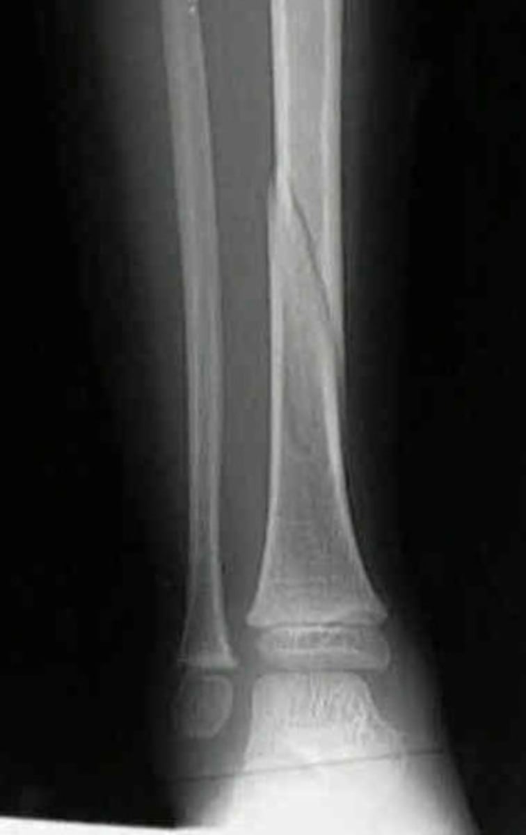 <p>- a fracture that twists around the shaft of the bone.</p><p>- The full extent of the fracture might not be realised without full-length imaging. This is why it is important to include all of the anatomy when imaging the tib/fib.</p>