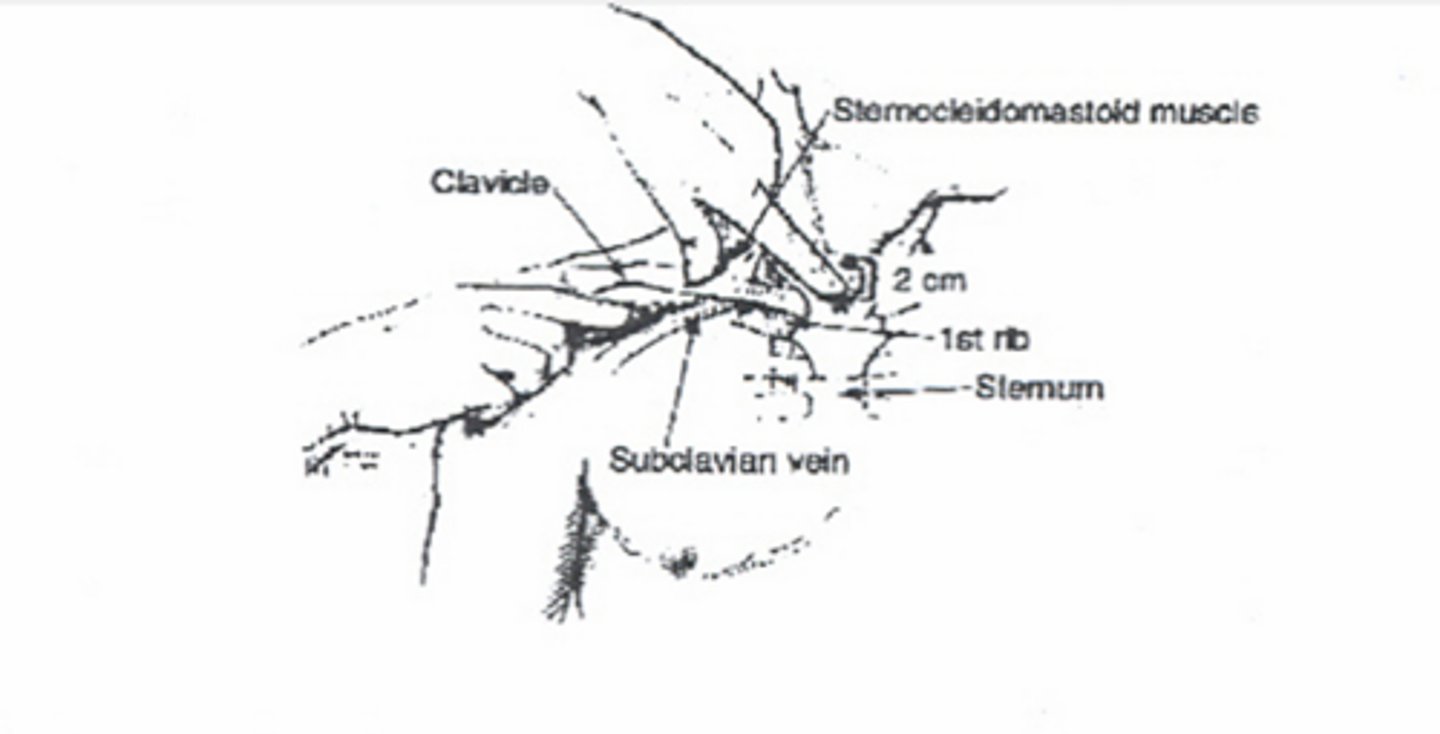 <p>-Right side preferred</p><p>-Palpate tubercle of clavicle 1/3 to 1/2 across</p><p>-1-2 cm below this spot</p><p>-Aim for the sternal notch with minimal angle off skin (parallel to ribs)</p><p>-"Hit" clavicle and use the other hand to coax underneath—pops right into vein</p>