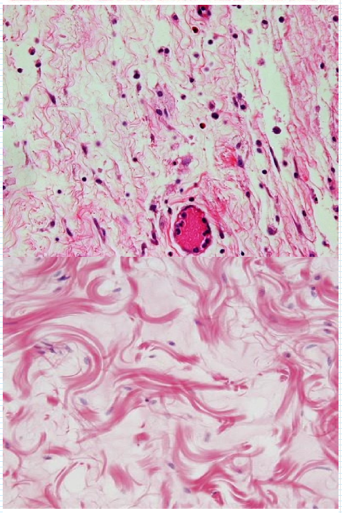 <p>= ‘loose connective tissue’ (‘areolar tissue’)</p><ul><li><p>los geweven, vult ruimten tussen spiervezels en fasciën, ondersteunt epitheel &amp; omgeeft bloed- en lymfevaten</p></li><li><p>tot deze categorie behoren:</p><ul><li><p>papillaire dermis van de huid</p></li><li><p>onderhuidse bindweefsel (subcutis) van de huid</p></li></ul></li><li><p>meest frequent voorkomende cellen:</p><ul><li><p>fibroblasten</p></li><li><p>macrofagen</p></li></ul></li><li><p>collagene &amp; elastische vezels</p></li><li><p>sterk gevasculariseerd = sterk doorbloed</p></li><li><p>zeer reactief bindweefsel:</p><ul><li><p>relatief grote rijkdom aan cellen (fibroblasten &amp; macrofagen)</p></li><li><p>onderling goed verschuifbare losse collagene bundels &amp; elastine-netten</p></li><li><p>sterke vascularisatie</p></li></ul></li><li><p>cellulaire functies meer op de voorgrond</p><ul><li><p>gebeurtenissen die in samenhang met de bloedvaten optreden (bv. oedeem, ontsteking, overgevoeligheidsreacties)</p></li></ul></li></ul><p></p>
