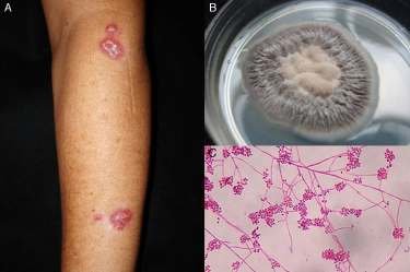<p>ESPOROTRICOSIS </p><p>INFECCIÓN CRÓNICA GRANULOMATOSA, PUEDE DISEMINARSE Y AFECTA. Ganclios yV. LINFÁTICOS DRENANTES.</p><p>Gram +</p>