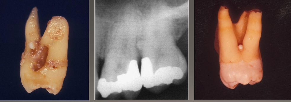 <ul><li><p>Enamel nodules at furcation of multi-rooted teeth</p></li><li><p>Most common site: Maxillary molars</p></li><li><p>May have pulp tissue, usually without dentin</p></li><li><p>Problem: Perio defect and pulp exposure</p></li></ul><p></p>