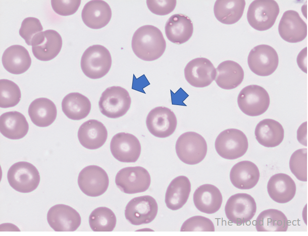 <ul><li><p>bull’s-eye shaped cells</p></li><li><p>happens due to an <u>artifact</u>, <u>decreased Hgb</u>, or <u>increased red cell surface membrane</u></p></li><li><p><strong>seen in those with</strong> IDA, hemoglobin C disease, liver disease, and a splenectomy</p></li></ul><p></p>