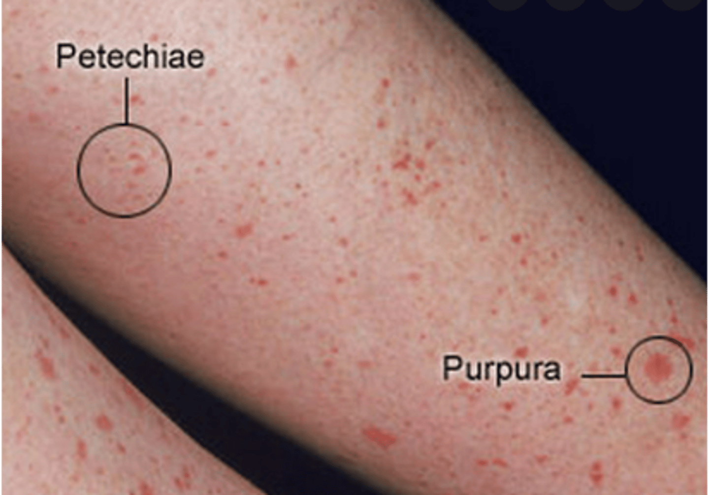 <p>Petechiae: Reddish-purple macules &lt;4 mm</p><p>Purpura: Reddish-purple macules, 4 mm - 10mm</p>