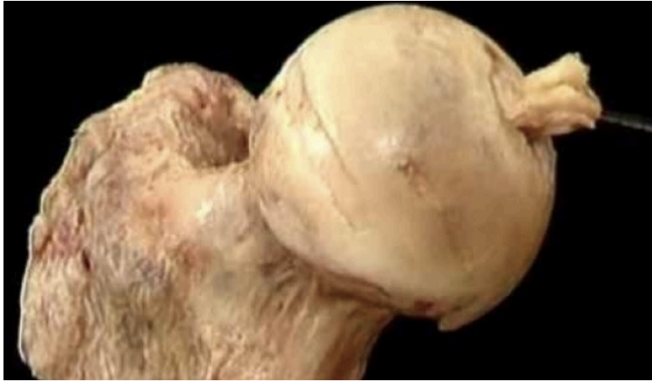 <p>Avascular Necrosis</p>