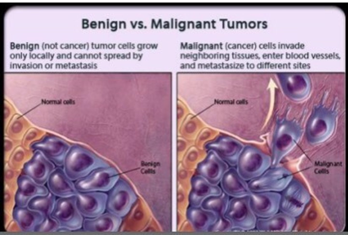 <p>abnormal cells with the ability to invade nearby tissue and migrate to other parts of the body (cancerous cells)</p>