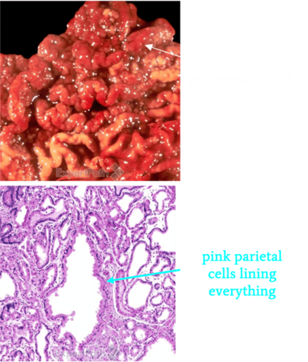 <p>Define Condition:</p><p>(info)</p><p>-Hx:</p><p>&gt; Duodenal/Pancreatic Islet Cell Tumor (Gastrinoma)</p><p>&gt; MEN1 = Pancreatic Gastrinomas</p><p>-Path:</p><p>&gt; HYPERPLASIA OF PARIETAL CELLS &amp; Large Gastric Folds + PUD</p><p>&gt; Multiple ulcers in the stomach, duodenum, and even ​jejunum</p><p>-Sx:</p><p>&gt; GERD Like</p><p>&gt;&gt; Heartburn</p><p>&gt;&gt; Dysphagia</p><p>&gt;&gt; Regurgitation of Sour-tasting gastric contents</p><p>&gt;&gt; Asthma-like Sx (Aspiration of acid in trachea --&gt; Coughing, Wheezing, Pneumonia)</p><p>&gt;&gt; Retrosternal Chest Pain</p><p>&gt; PUD Like = Epigastric Pain around Meals</p><p>&gt; Diarrhea (More acidity in duodenum --&gt; Less pancreatic digestive enzymes ==&gt; Fat malabsorption)</p><p>-Dx:</p><p>&gt; Gross: Enlarged fundic mucosal folds with cerebriform pattern</p><p>&gt; Biopsy: Hyperplasia primarily of parietal cells in fundic glands</p>