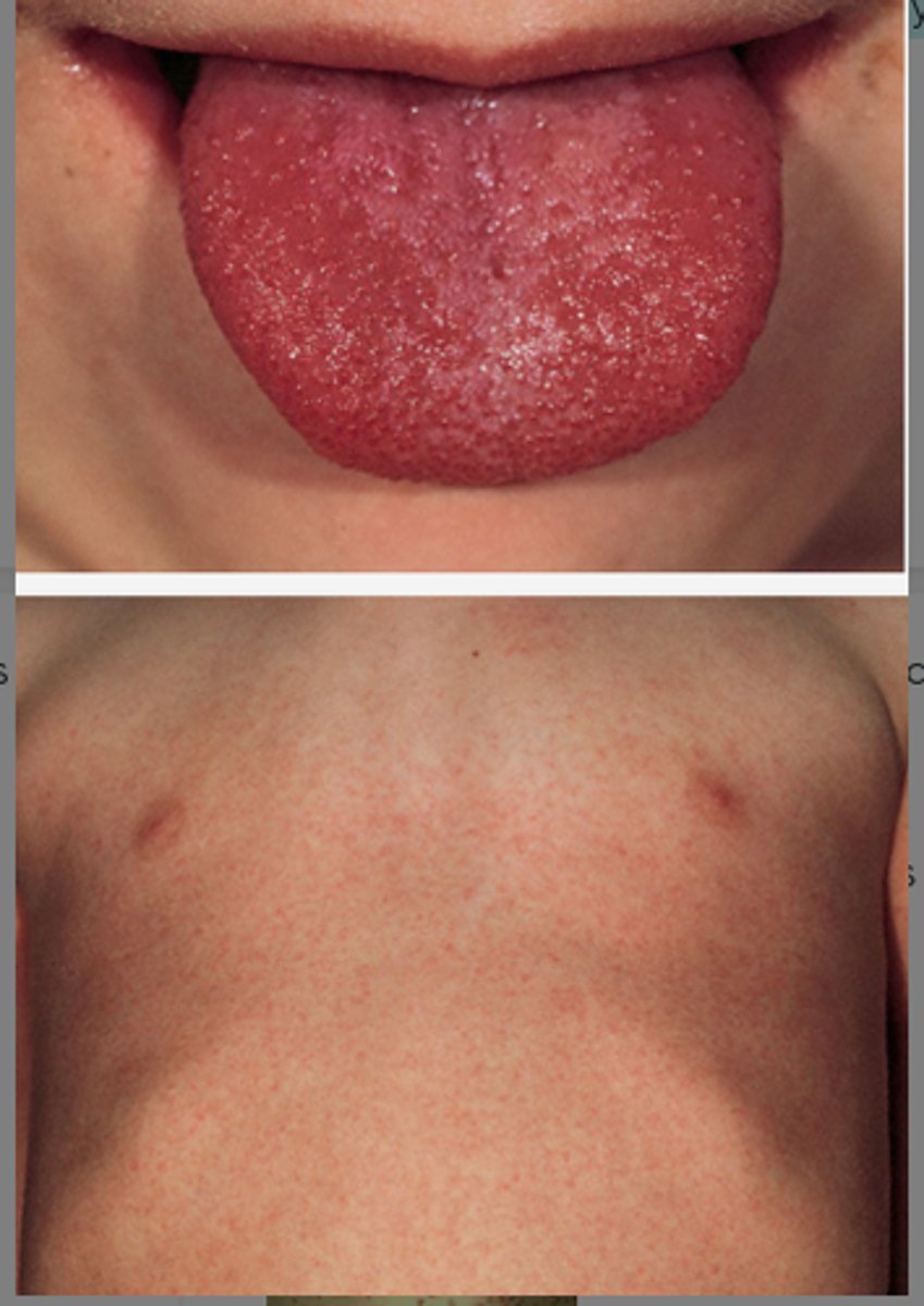 <p>- Sandpaper rash</p><p>- Strawberry tongue</p><p>- Facial flushing with circumoral pallor</p><p>- Desquamation can occur</p><p>- Forchheimer spots: Small red spots on the soft palate that resolve quickly</p>