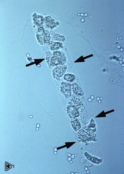 <p>Epithelial cell casts</p>