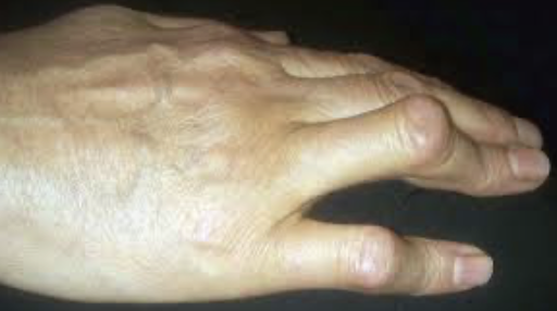 <p>extension of the MCP and DIP joints and flexion of the PIP joint </p>