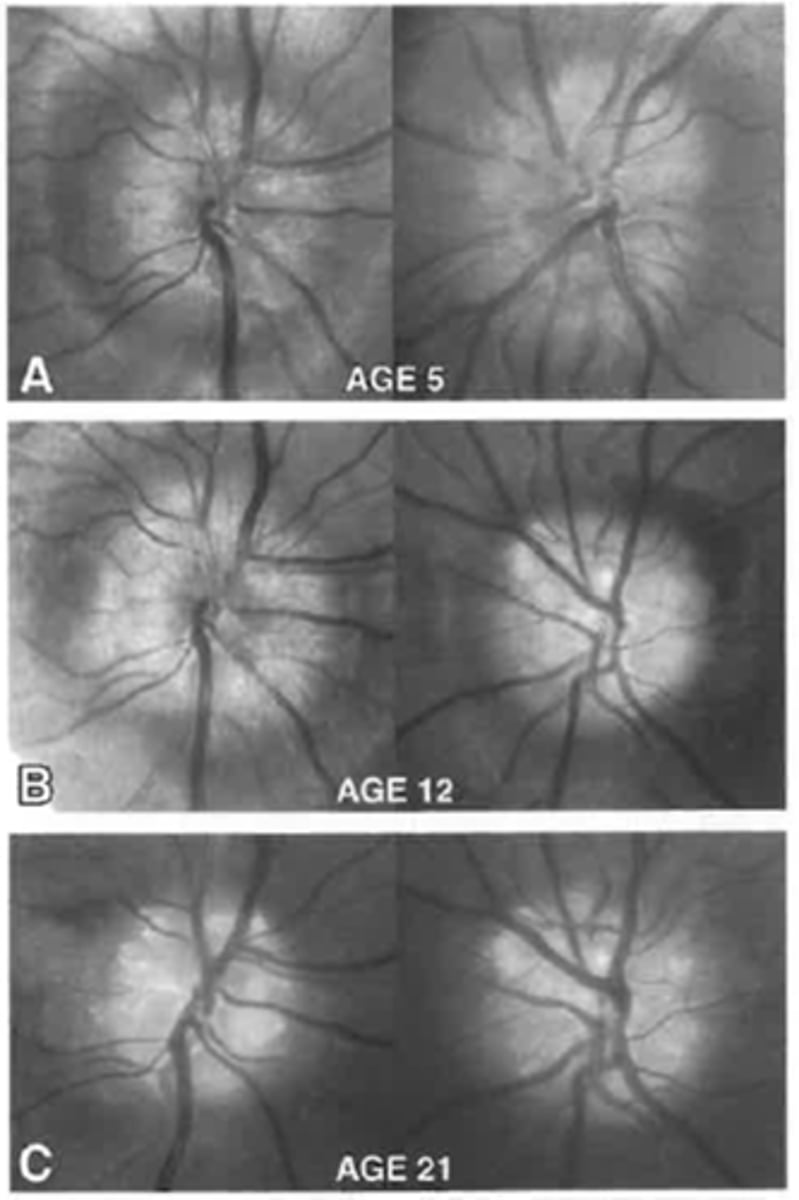 <p>buried drusen may migrate to the surface of the ONH</p>