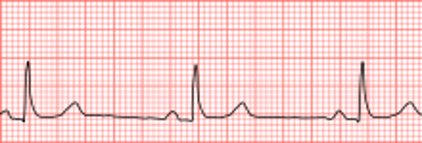 <p>P, QRS, and T waves</p>