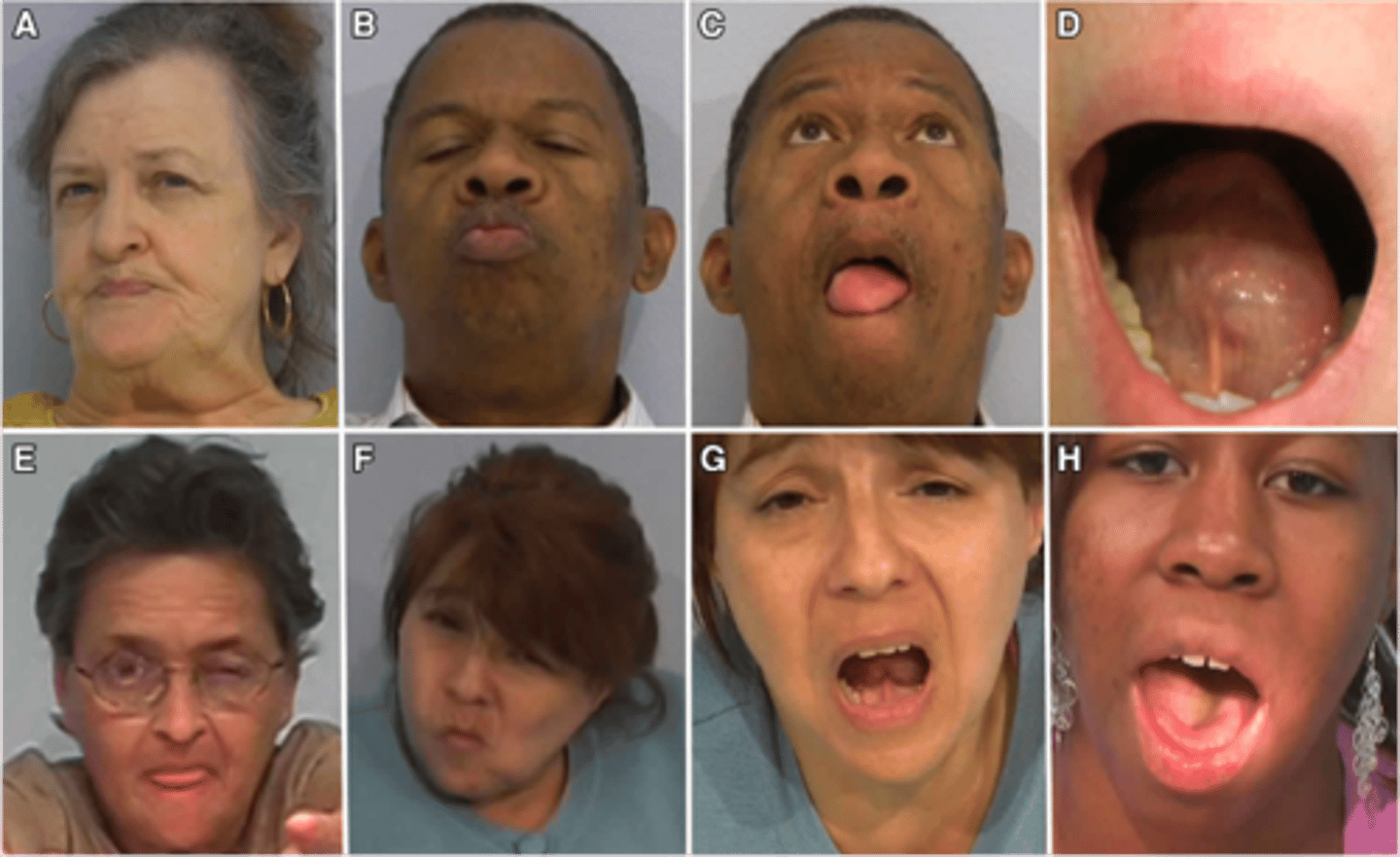 <p>Iatrogenic movement disorder causing involuntary, repetitive movements of the mouth, tongue, face, trunk, &amp; limbs; neuroleptic (antipsychotic) use</p>