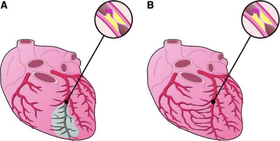 <p>slow (picture B - this is why someone can have a 100% occlusion and no symptoms of a MI) </p>