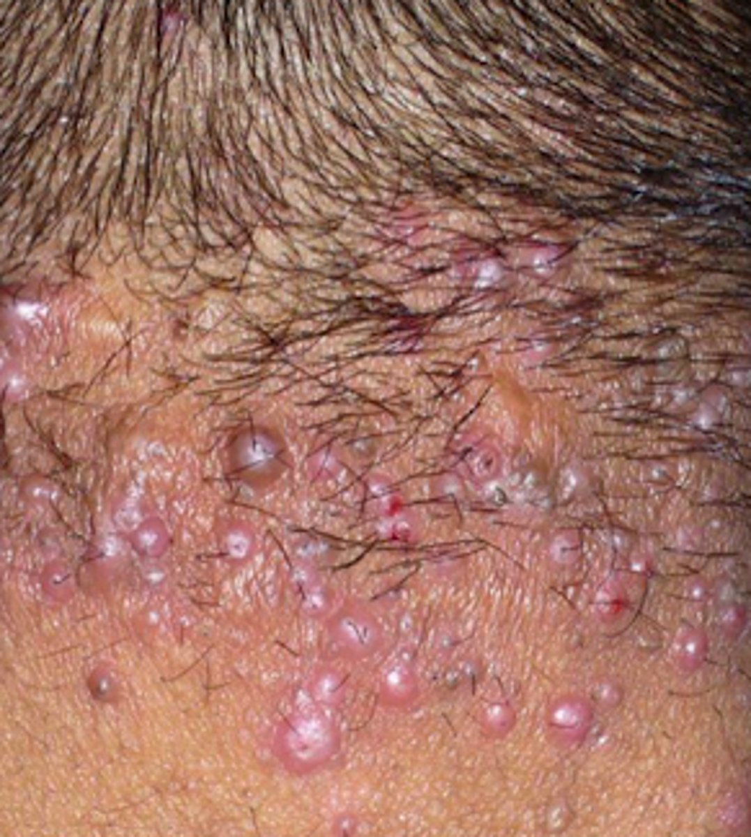 <p>Bacterial Skin Infections:</p><p>If a patient presented w/ the following S/S, what may we suspect they have:</p><p>- multiple erythematous papules and some pustules</p><p>- found in areas of hair growth</p><p>- Usual non-tenderness, some <strong>pruritic</strong></p>