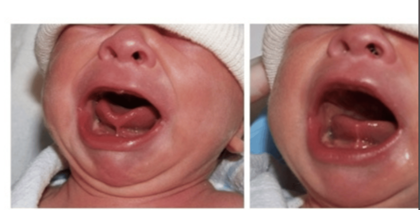 <p>What is the treatment for Ankyloglossia in severe cases for infants? </p>