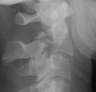<p>What type of fracture is this?</p>