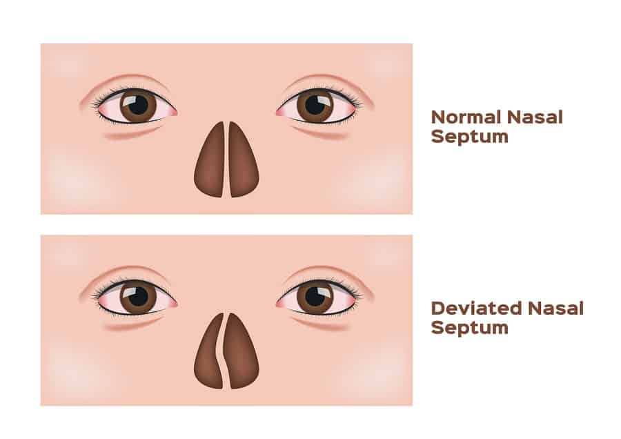 <p><span style="color: rgb(43, 49, 80)">A patient reveals to you that they were recently involved in a car accident that they believe resulted in a deviated septum. Which of the following bones may have been injured in the accident, resulting in the deviated septum?</span></p>
