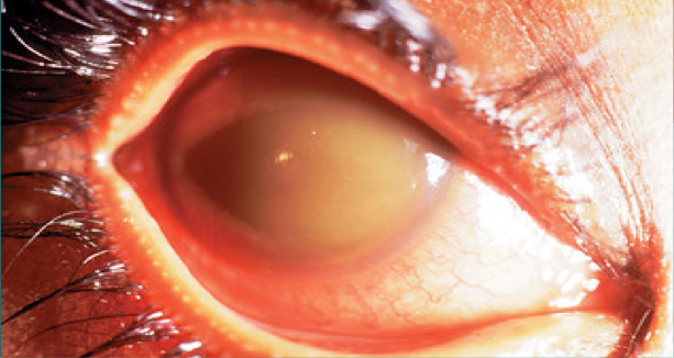 <p>Eye trauma- eye pain and blurred vision</p><p>Nausea and vomiting</p><p>Red eye</p><p>Layered blood in anterior chamber of eye</p><p>Corneal blood staining</p>