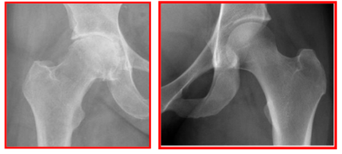 <p></p><p><span style="background-color: transparent; font-family: "Times New Roman", serif;"><strong><span>Sänkt ledspringa</span></strong><span> → Ledspringan är avståndet mellan benen i en led. Normalt håller brosket jämt avstånd men vid artros försvinner brosket och springan minskar. Detta är det tydligaste tecknet på artros.</span></span></p><p><span style="background-color: transparent; font-family: "Times New Roman", serif;"><strong><span>Osteofyter (benpålagringar)</span></strong><span> → ostefyter är små benknölar eller utskott som bildas längs ledkanterna. De bildas för att stabilisera en skadad led. Syns som utväxter längs ledens kanter.</span></span></p><p><span style="background-color: transparent; font-family: "Times New Roman", serif;"><strong><span>Subkondral skleros → </span></strong><span>Förtjockning och förhårdning av benet precis under brosket (subkondralt ben). Syns som ljusare, tätare område på röntgen. När brosket inte längre dämpar stötar → mer kraft överförs direkt till benet vilket gör benet tätare och hårdare.</span></span></p><p><span style="background-color: transparent; font-family: "Times New Roman", serif;"><strong><span>Subkondrala cystor</span></strong><span> → små hålrum i benet fyllda med vätska. Uppstår pga ökat tryck i leden så synoviqalvätska pressas in i benet eller mikroskopiska fraktirer.&nbsp;</span></span></p><p><br></p>